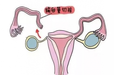 甘肃慈铭博鳌国际医院三代试管婴儿，切除双侧输卵管还能做试管婴儿吗？